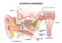 Does Acoustic Neuroma Cause Sensorineural Hearing Loss?